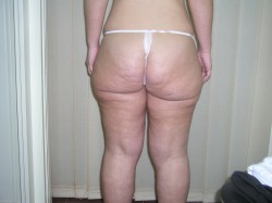 Cellulite rimozione